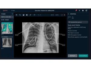 qure ai-xrays