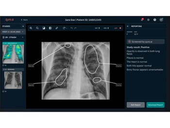 qure ai-xrays