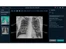 qure ai-xrays