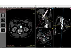 RadiAnt DICOM Viewer-MPR