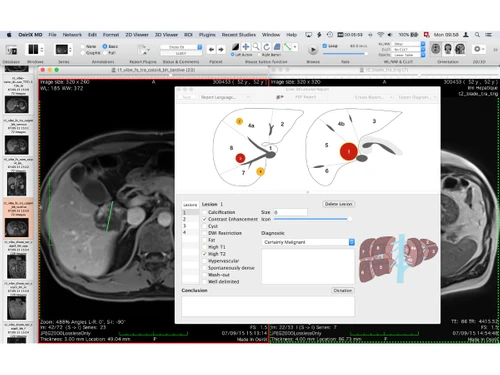 OsiriX MD-2d viewer