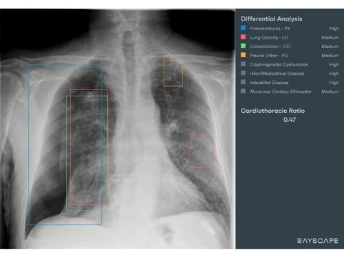 Rayscape-lung analysis