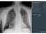 Rayscape-lung analysis