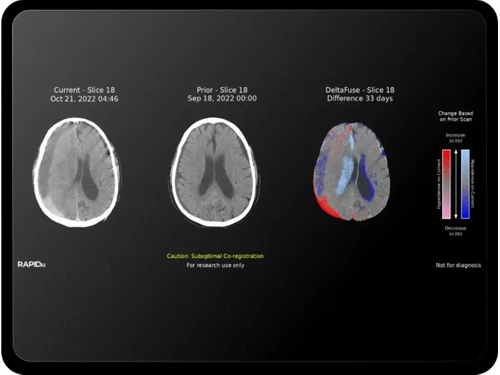 RapidAI-neurovascular
